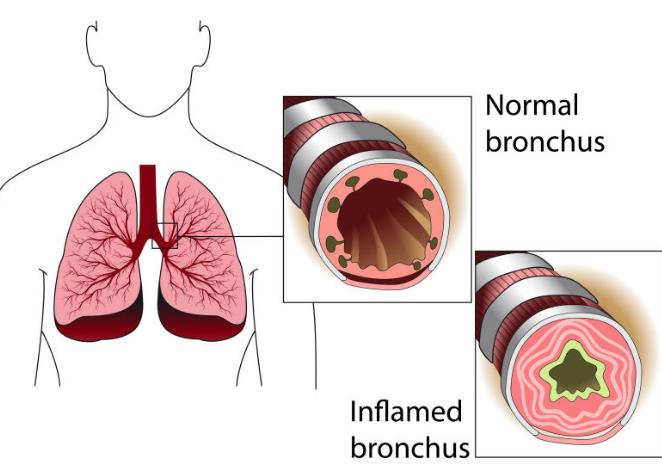 哮喘.jpg